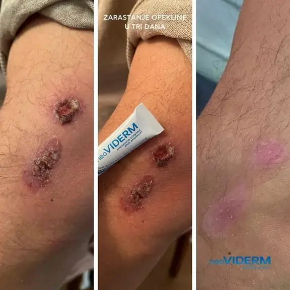 Healing of a burn after three days