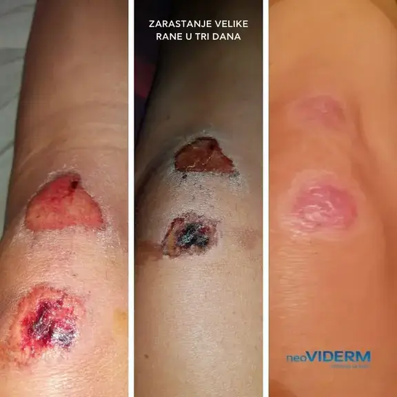 Healing of a large wound in three days
