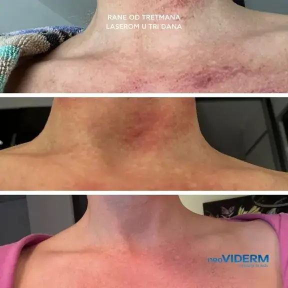 Wounds from laser treatment in three days