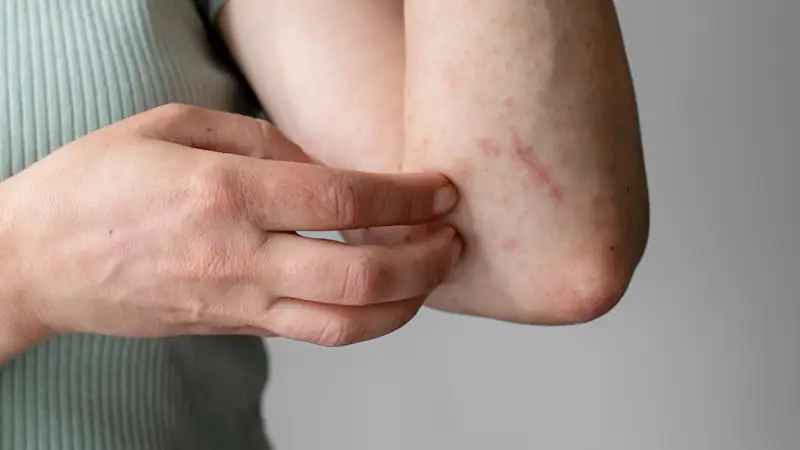 Mosquito bites - a thing of the past