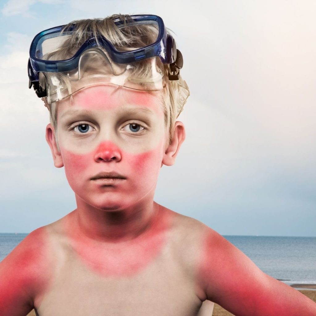 Opekline od sunca – što ako ih unatoč SPF-u zadobijete?