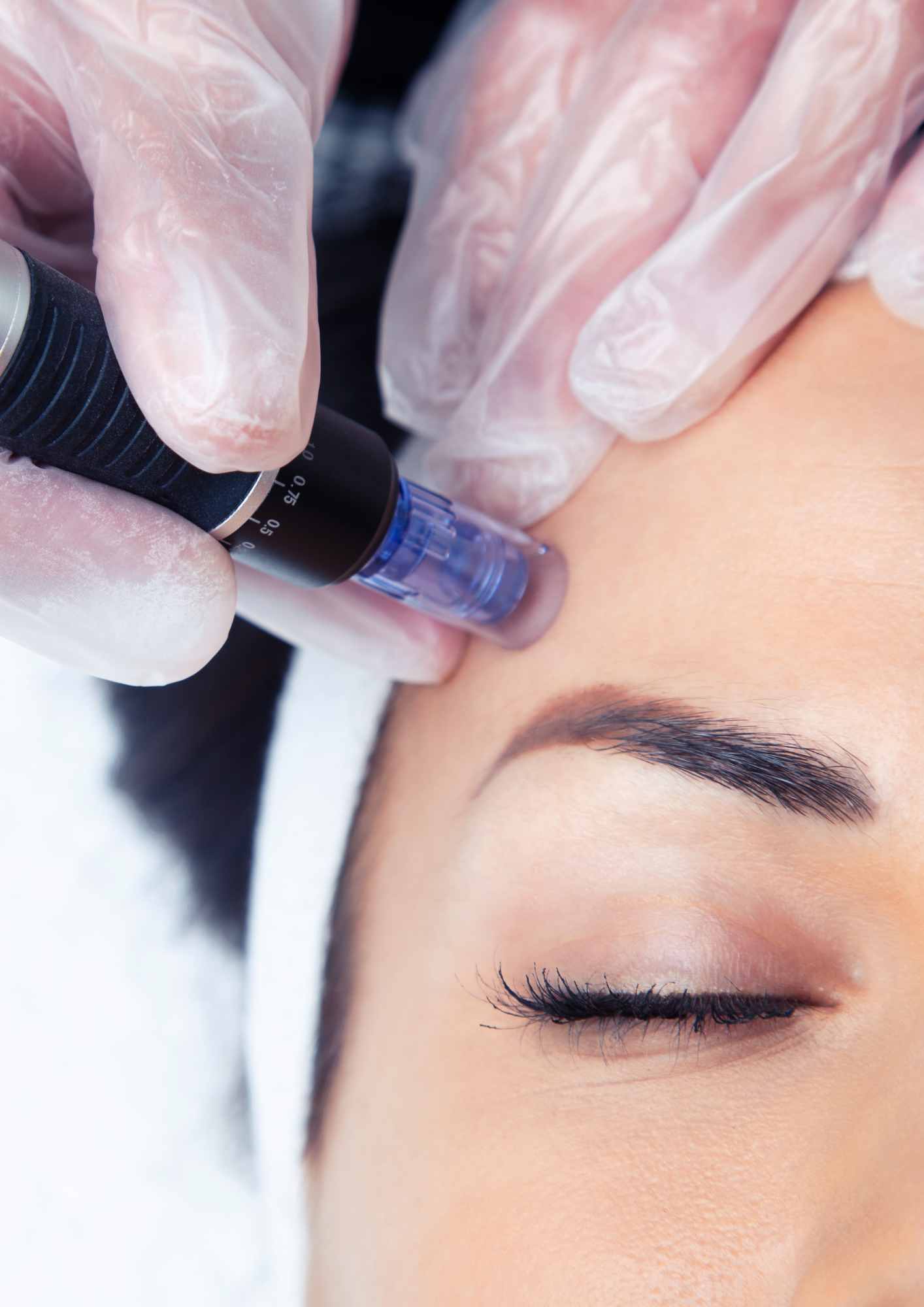 Microneedling tretman i njega kože nakon tretmana
